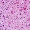 7B4 Oligodendroglioma, anaplastic Grade 3 (Case 7) H&E 9