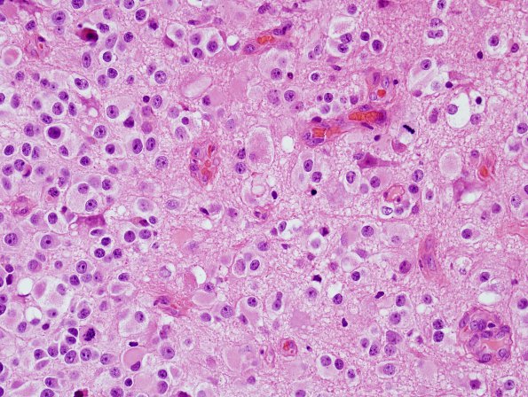 7B4 Oligodendroglioma, anaplastic Grade 3 (Case 7) H&E 9