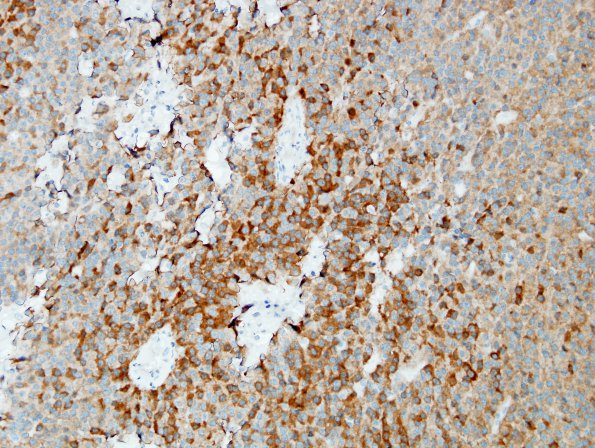 7C Oligodendroglioma, anaplastic Grade 3 (Case 7) IDH1 1