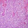 8A1 Oligodendroglioma, anaplastic (Case 8) H&E 5 IDH2 mut.jpg