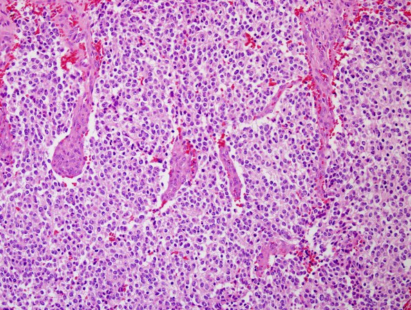 8A1 Oligodendroglioma, anaplastic (Case 8) H&E 5 IDH2 mut.jpg