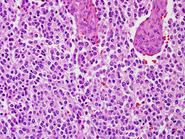 8A2 Oligodendroglioma, anaplastic (Case 8) H&E 1 IDH2 mut.jpg