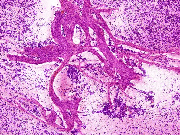 9A1 Oligodendroglioma, anaplastic (Case 9) H&E smear 3.jpg