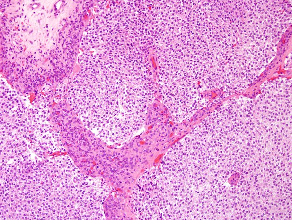 9A2 Oligodendroglioma, anaplastic (Case 9) H&E 1.jpg