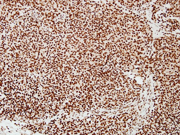 9B Oligodendroglioma, anaplastic (Case 9) ATRX 1.jpg