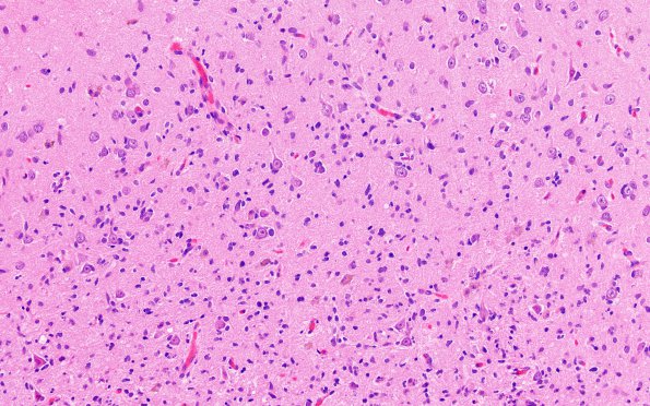 1A4 PLNTY (Case 1) A1 H&E 2