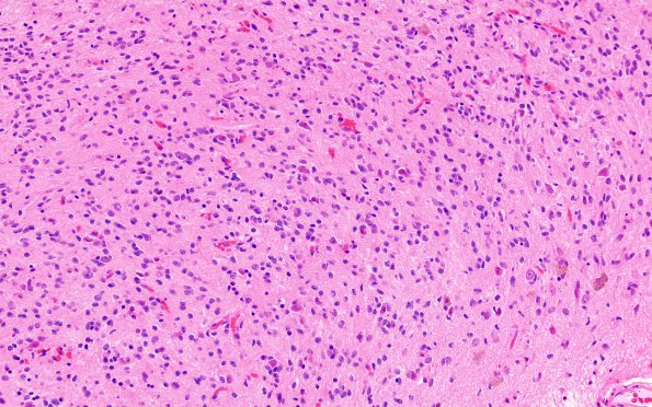 1A5 PLNTY (Case 1) A1 H&E 3