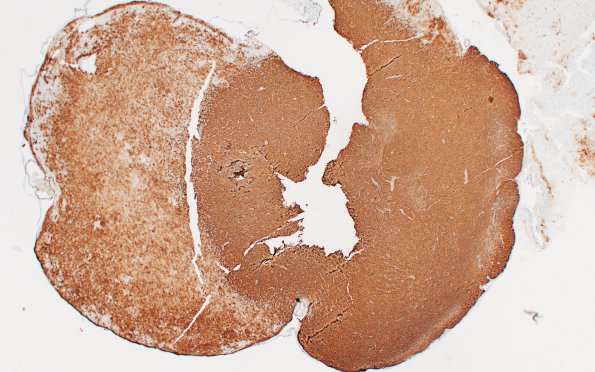 1C6 PLNTY (Case 1) A1 CD34 4X 1