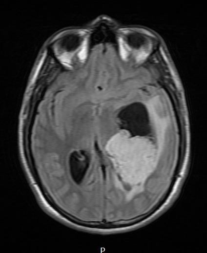 2A1 PLNTY (Case 2, Resection 1) FLAIR - Copy