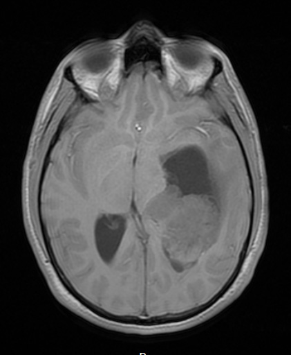 2A2 PLNTY (Case 2, Resection 1) T1 no C - Copy