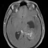 2A3 PLNTY (Case 2, Resection 1) T1W - Copy