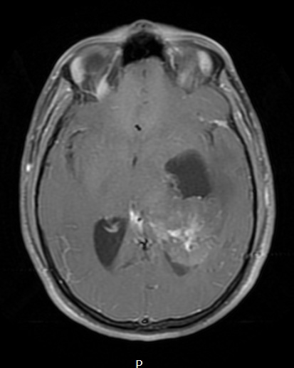 2A3 PLNTY (Case 2, Resection 1) T1W - Copy