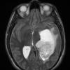 2A4 PLNTY (Case 2, Resection 1) T2 no C - Copy