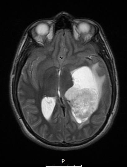 2A4 PLNTY (Case 2, Resection 1) T2 no C - Copy