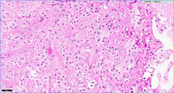 2D2 PLNTY (Case 2, Resection 2) H&E 2