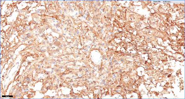 2E2 PLNTY (Case 2, Resection 2) CD34 20X 2