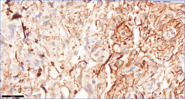 2E3 PLNTY (Case 2, Resection 2) CD34 40X 2