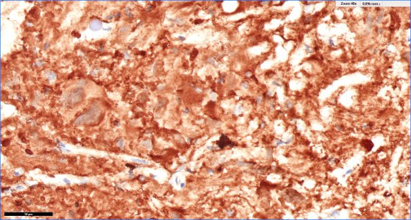 2E4 PLNTY (Case 2, Resection 2) CD34 40X