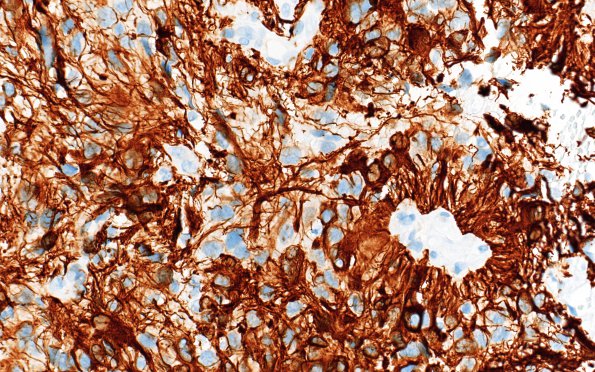 2K3 PLNTY (Case 2, Resection 4) A3 GFAP 40X 2