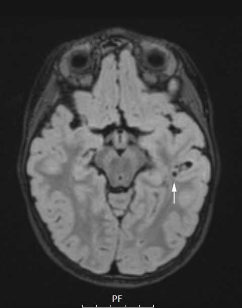 3A1 PLNTY (Case 3, Resection 1) FLAIR - Copy copy