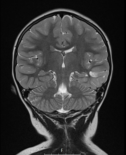 3A3 PLNTY (Case 3, Resection 1) T2 COR - Copy