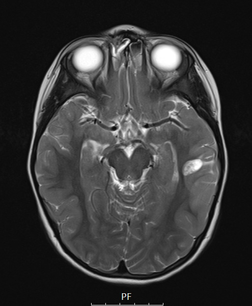 3A4 PLNTY (Case 3, Resection 1) T2W - Copy