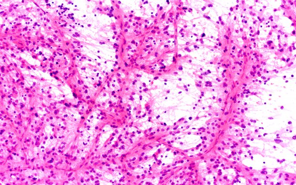 3B1 PLNTY (Case 3, Resection 1) smear H&E 20X