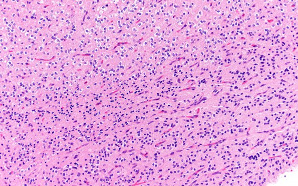 3H2 PLNTY (Case 3, Resection 2) H&E 2