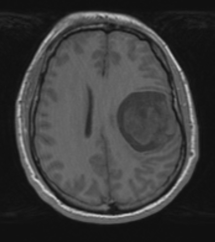 17A2 PXA Anaplastic WHO III (Case 17) T1 noC - Copy