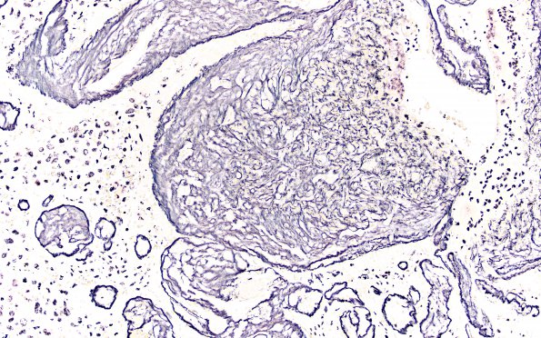 17F PXA Anaplastic WHO III (Case 17) Retic 20X