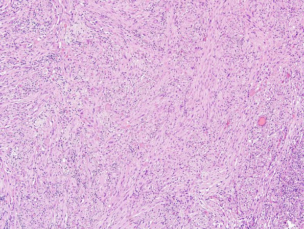 18A1 Pleomorphic Xanthoastrocytoma (Case 18) H&E 9