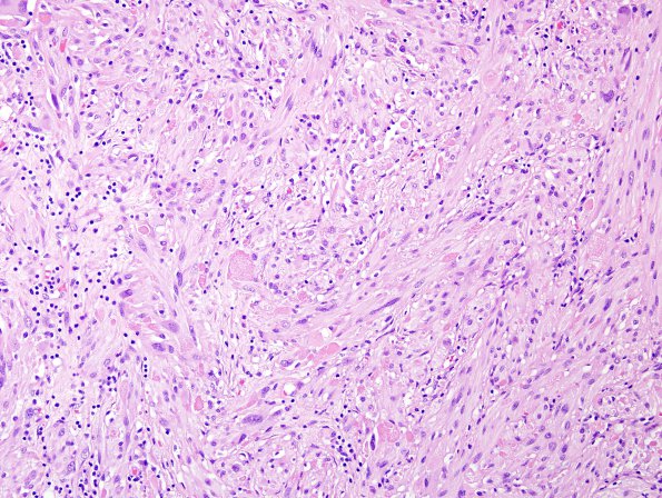 18A2 Pleomorphic Xanthoastrocytoma (Case 18) H&E 7