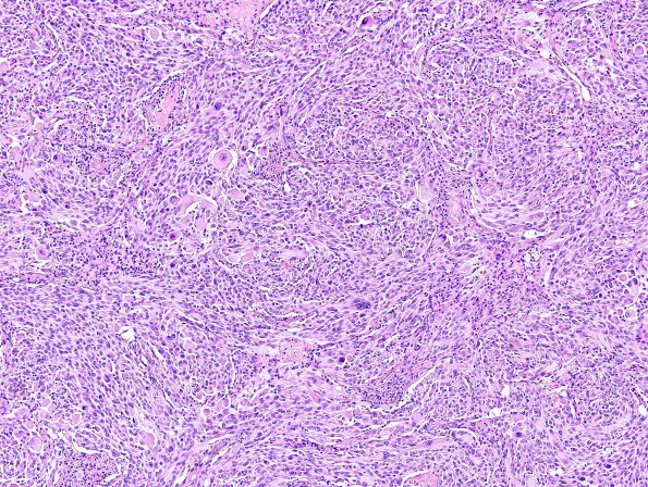 18A3 Pleomorphic Xanthoastrocytoma (Case 18) H&E 12