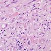 18A4 Pleomorphic Xanthoastrocytoma (Case 18) H&E 5