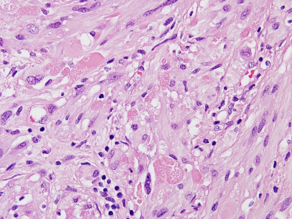 18A4 Pleomorphic Xanthoastrocytoma (Case 18) H&E 5