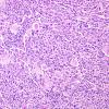 18A5 Pleomorphic Xanthoastrocytoma (Case 18) H&E 16