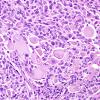 18A6 Pleomorphic Xanthoastrocytoma (Case 18) H&E 15