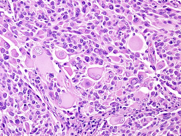 18A6 Pleomorphic Xanthoastrocytoma (Case 18) H&E 15