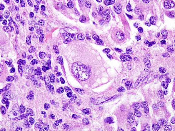 18A7 Pleomorphic Xanthoastrocytoma (Case 18) H&E 17