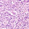 18A8 Pleomorphic Xanthoastrocytoma (Case 18) H&E 22