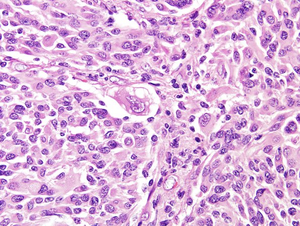 18A8 Pleomorphic Xanthoastrocytoma (Case 18) H&E 22