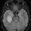 1A1 Pleomorphic Xanthoastrocytoma (Case 1) FLAIR - Copy