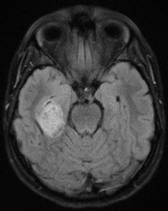 1A1 Pleomorphic Xanthoastrocytoma (Case 1) FLAIR - Copy