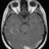 1A2 Pleomorphic Xanthoastrocytoma (Case 1) T1 W 2 - Copy