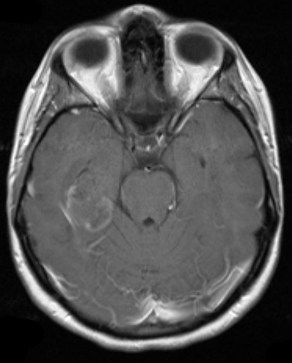 1A2 Pleomorphic Xanthoastrocytoma (Case 1) T1 W 2 - Copy