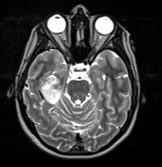 1A3 Pleomorphic Xanthoastrocytoma (Case 1) T2 - Copy