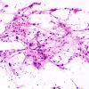 1B1 Pleomorphic Xanthoastrocytoma (Case 1) H&E smear 5