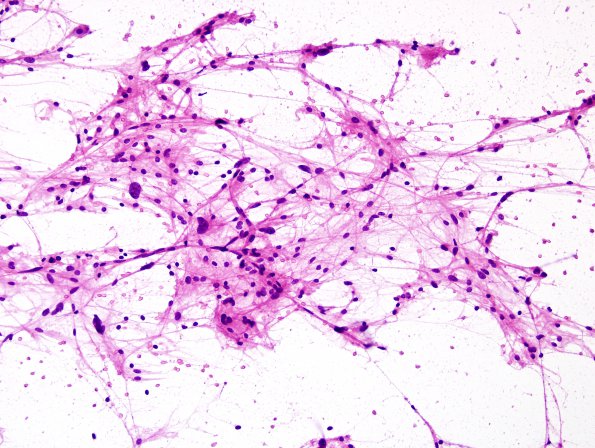 1B1 Pleomorphic Xanthoastrocytoma (Case 1) H&E smear 5