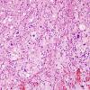 1B2 Pleomorphic Xanthoastrocytoma (Case 1) H&E 2