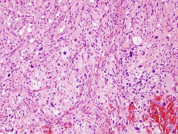 1B2 Pleomorphic Xanthoastrocytoma (Case 1) H&E 2